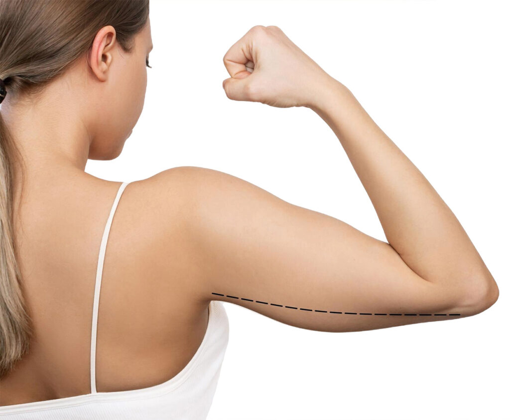 شد ترهلات الذراعين