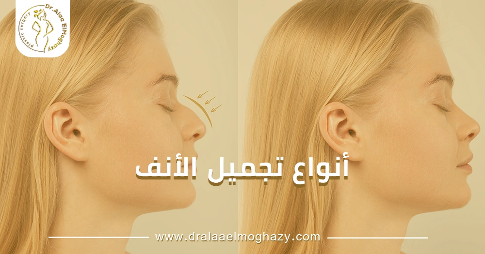 أنواع تجميل الأنف
