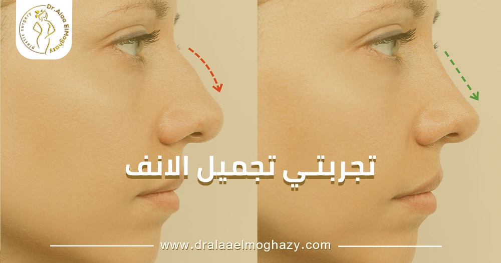 تجربتي تجميل الانف