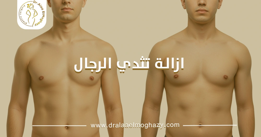ازالة تثدي الرجال