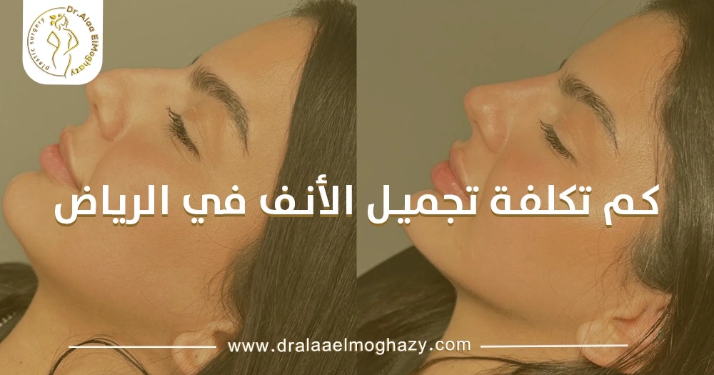 كم تكلفة تجميل الأنف في الرياض