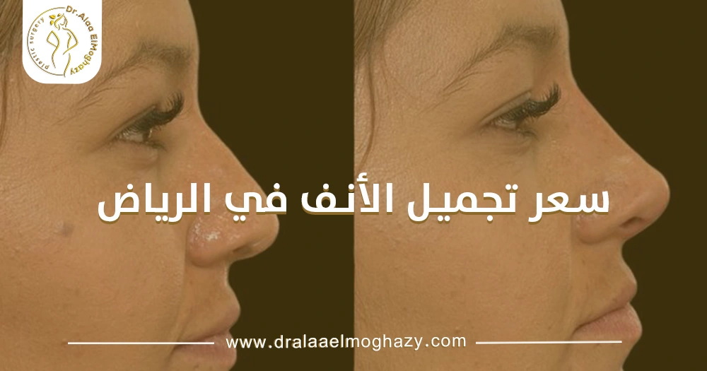 سعر تجميل الأنف في الرياض