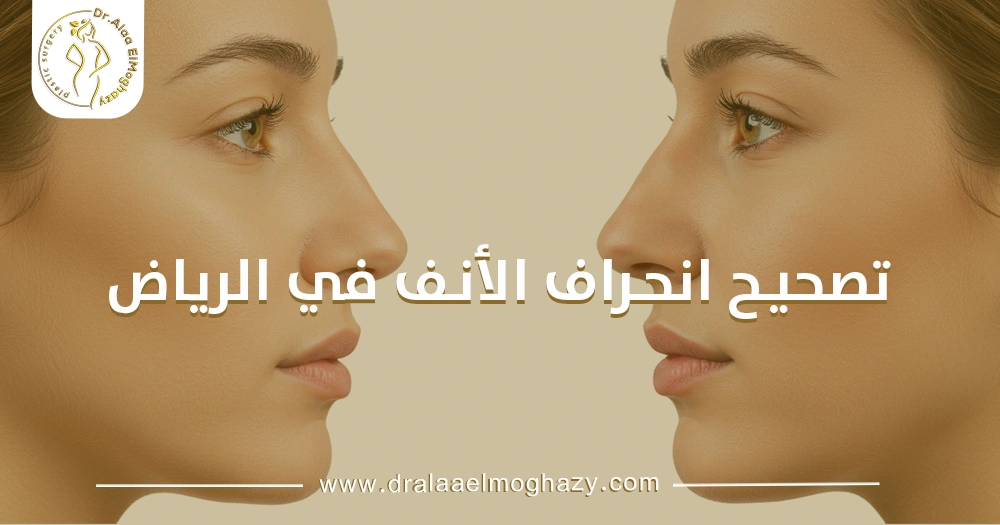تصحيح انحراف الأنف في الرياض