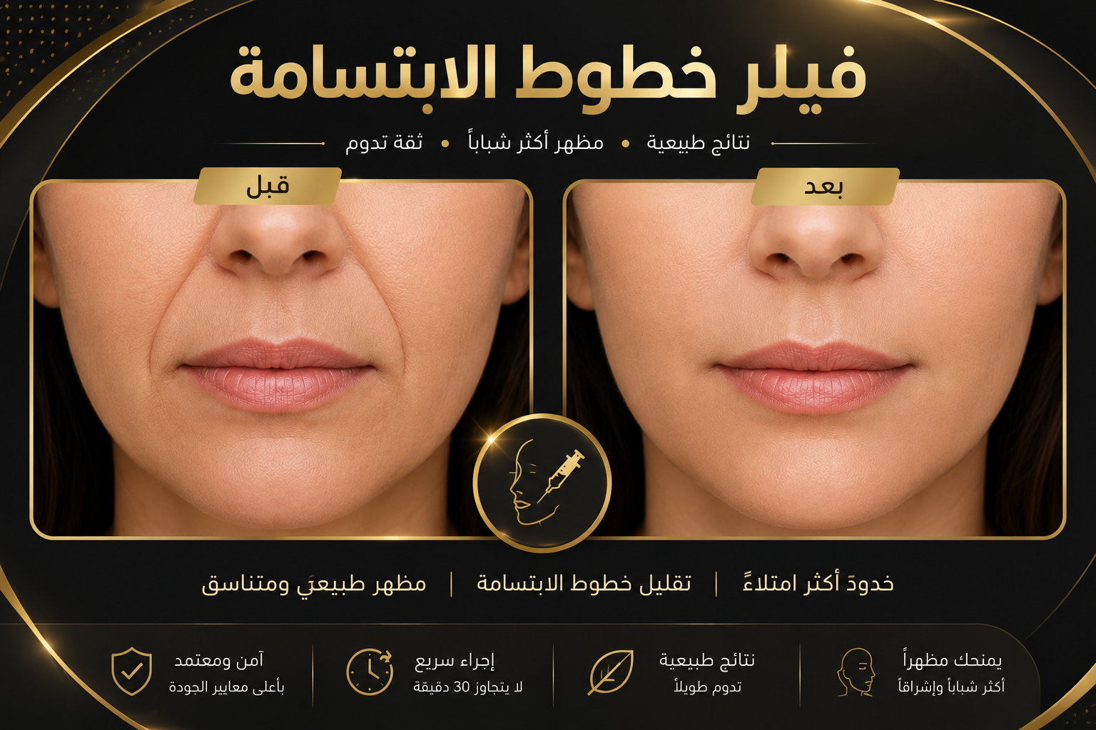 فيلر خطوط الابتسامة قبل وبعد